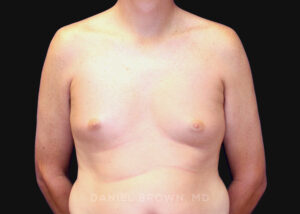 Male Breast Reduction - Case 2591 - After