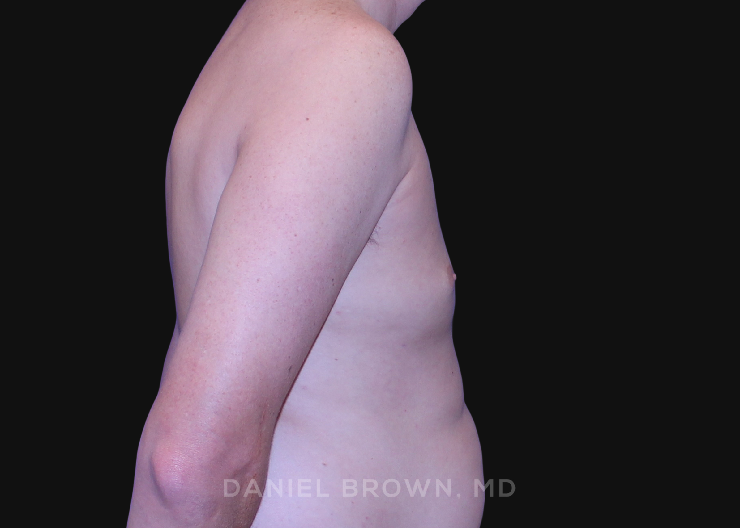 Male Breast Reduction Patient Photo - Case 2591 - after view