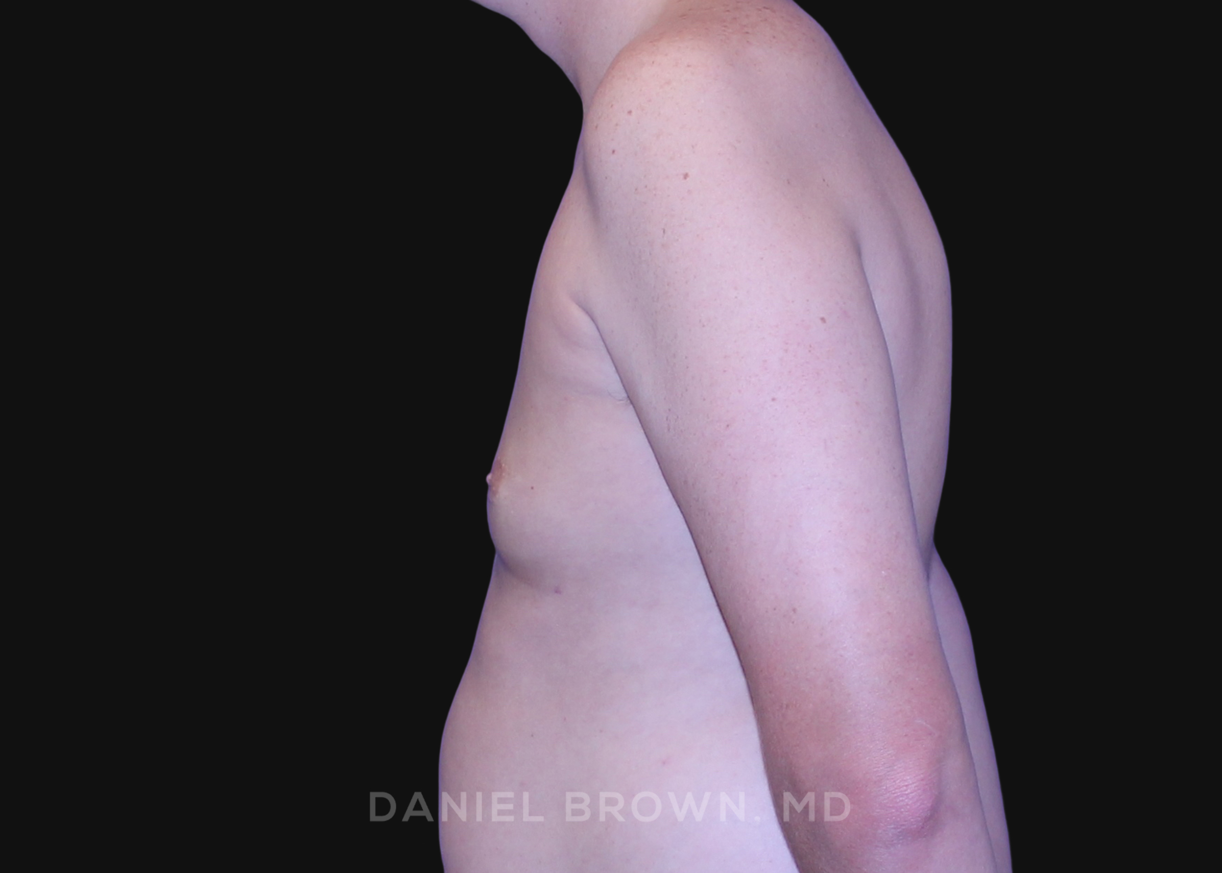 Male Breast Reduction Patient Photo - Case 2591 - before view-