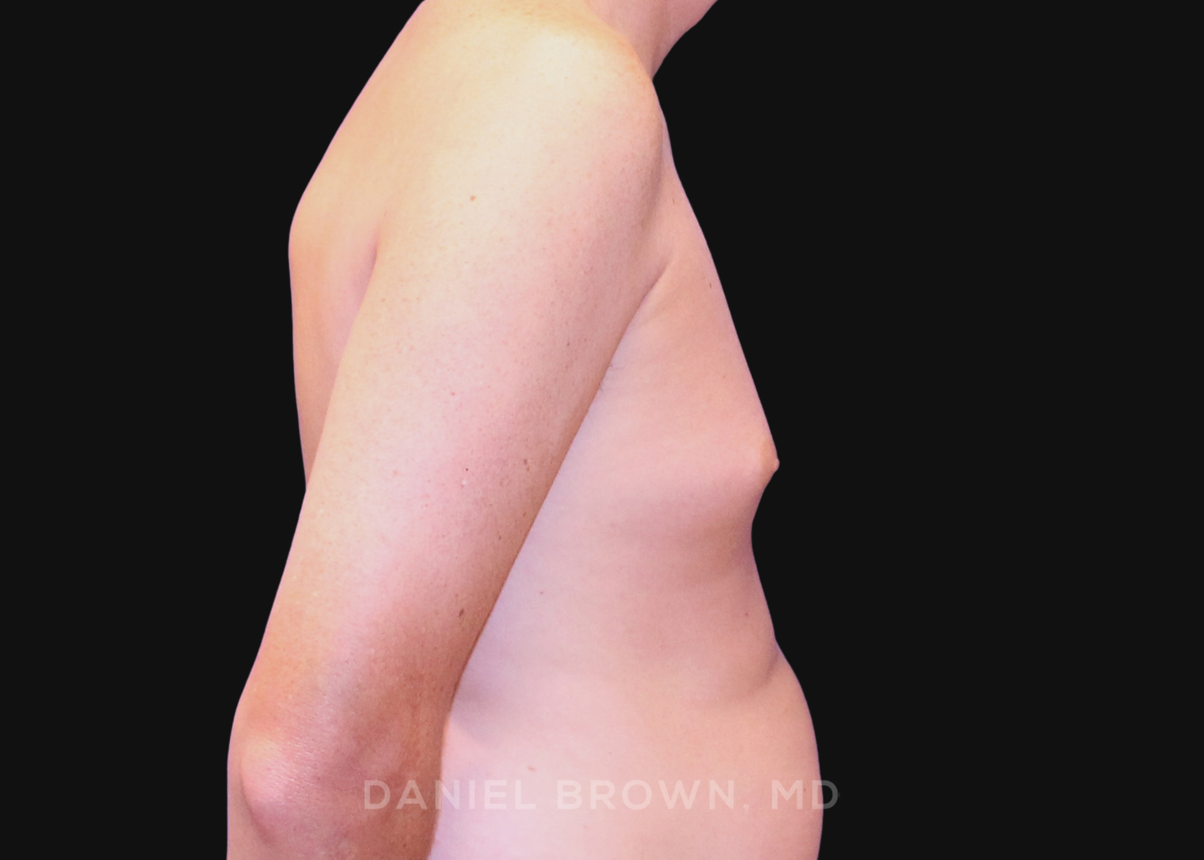 Male Breast Reduction Patient Photo - Case 2591 - after view