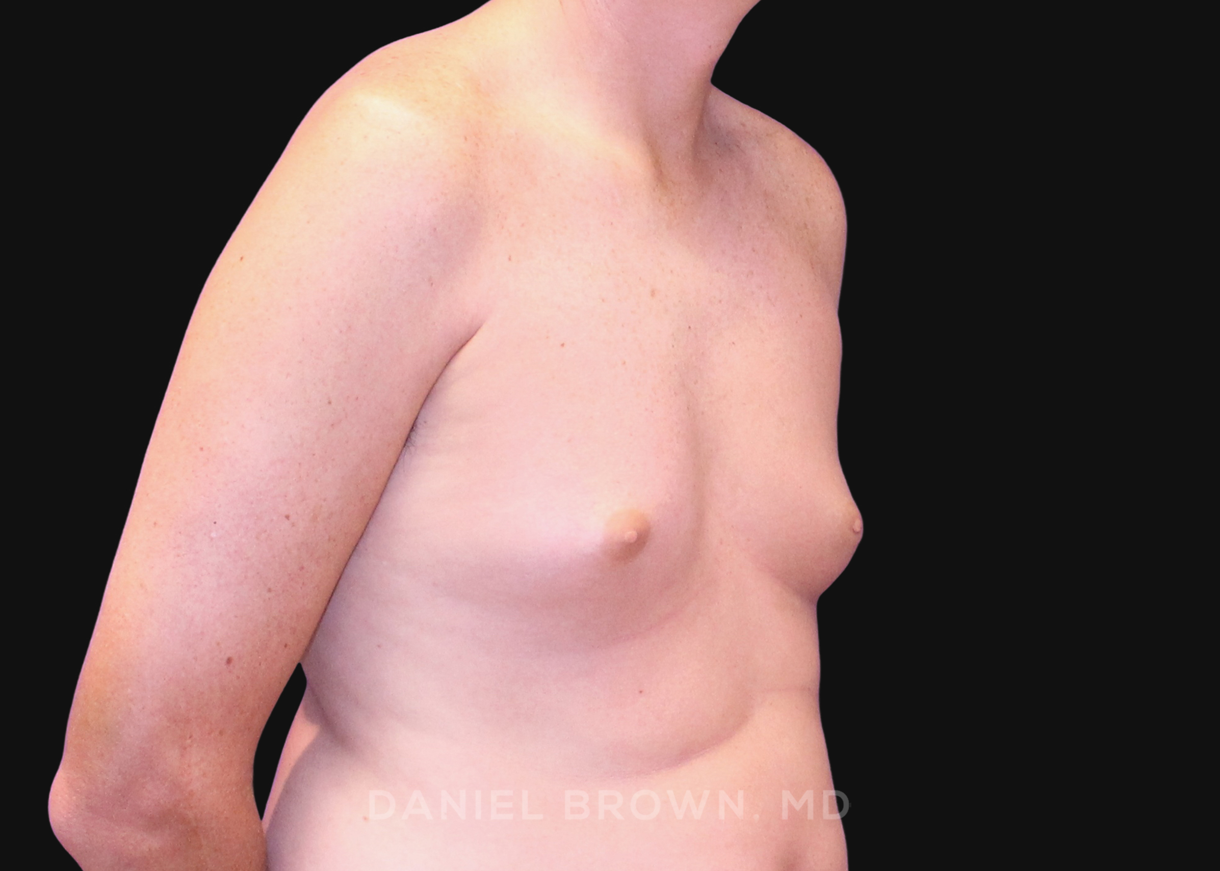Male Breast Reduction Patient Photo - Case 2591 - after view-2
