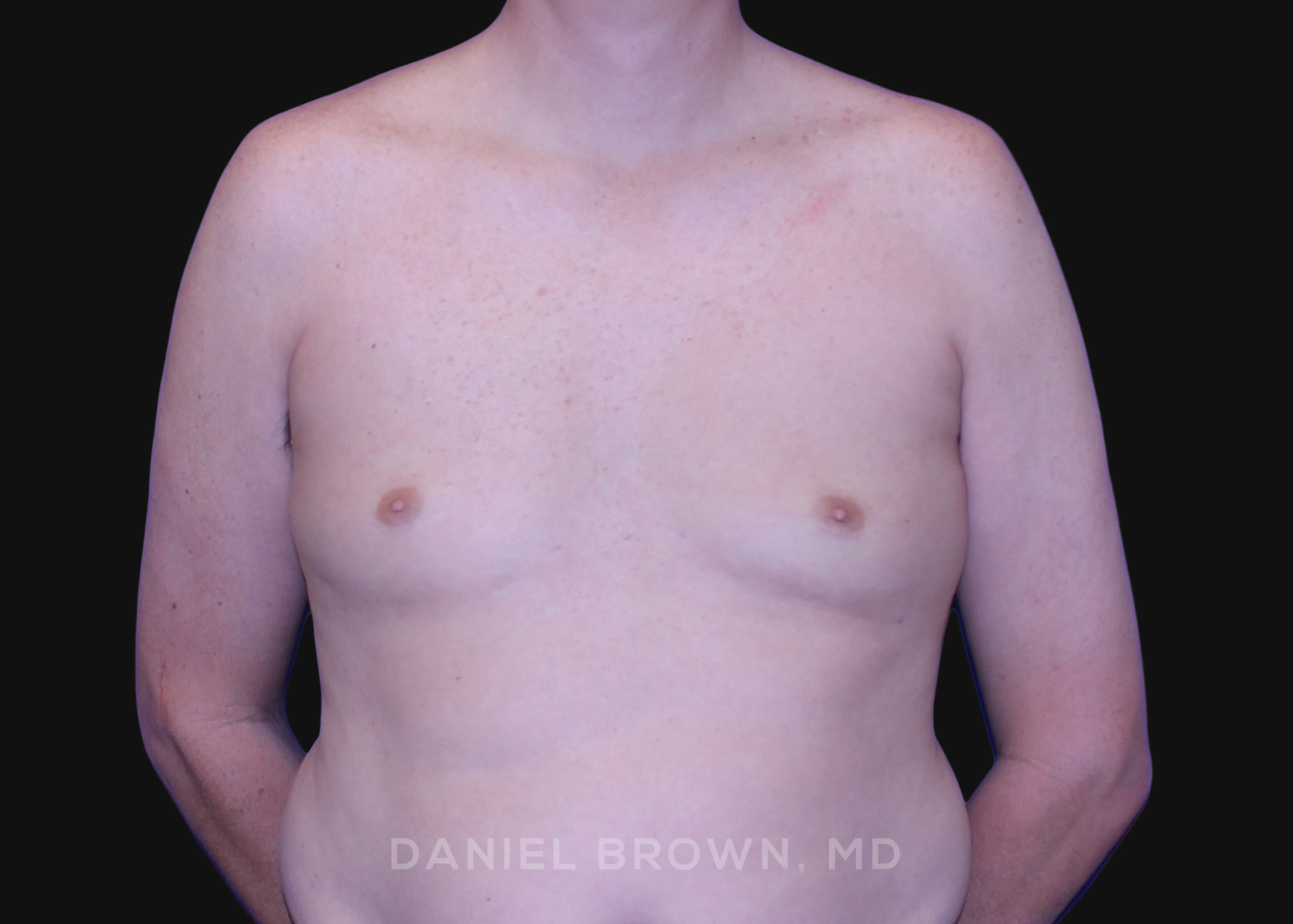Male Breast Reduction Patient Photo - Case 2591 - before view-