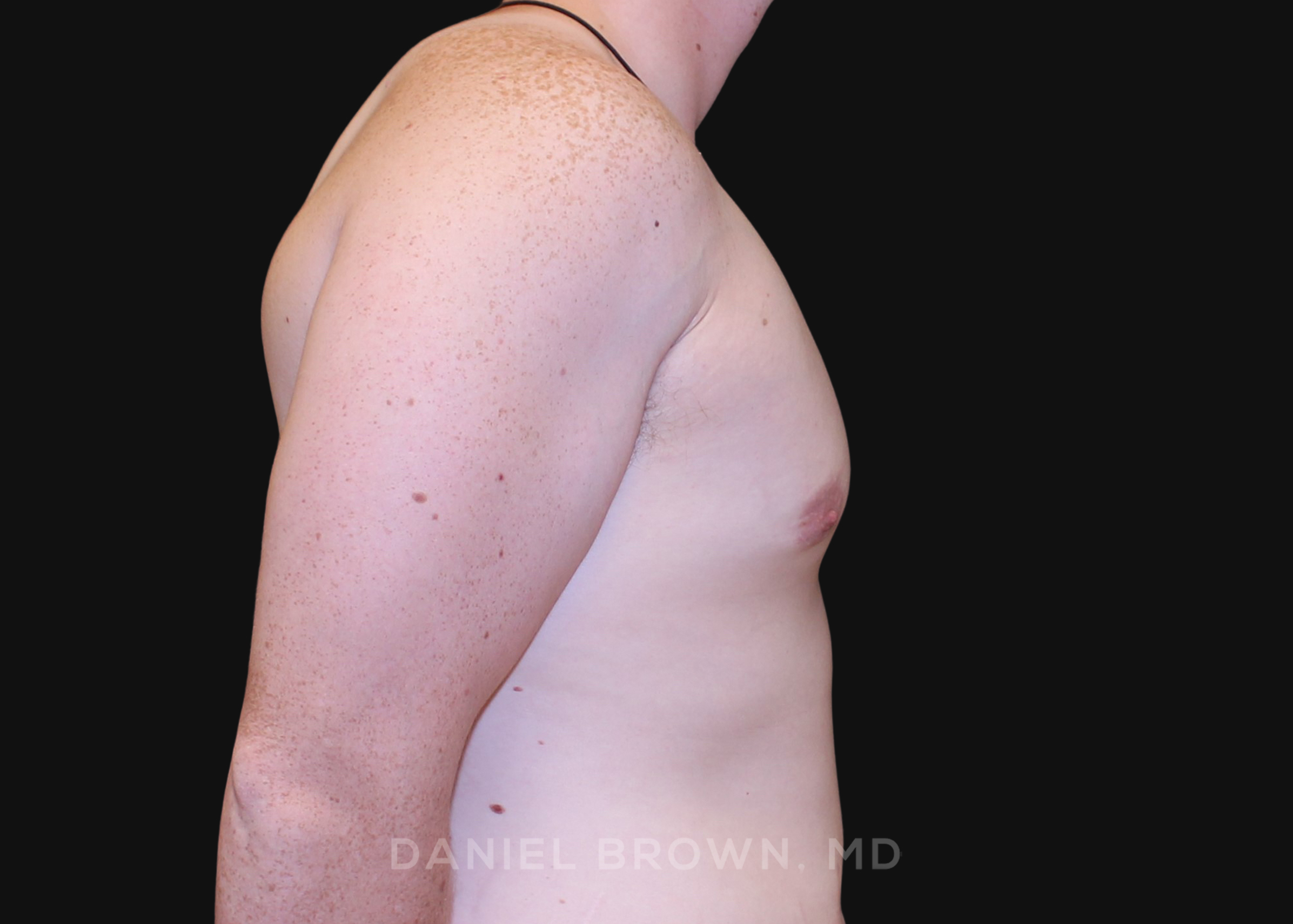 Male Breast Reduction Patient Photo - Case 2602 - after view-4