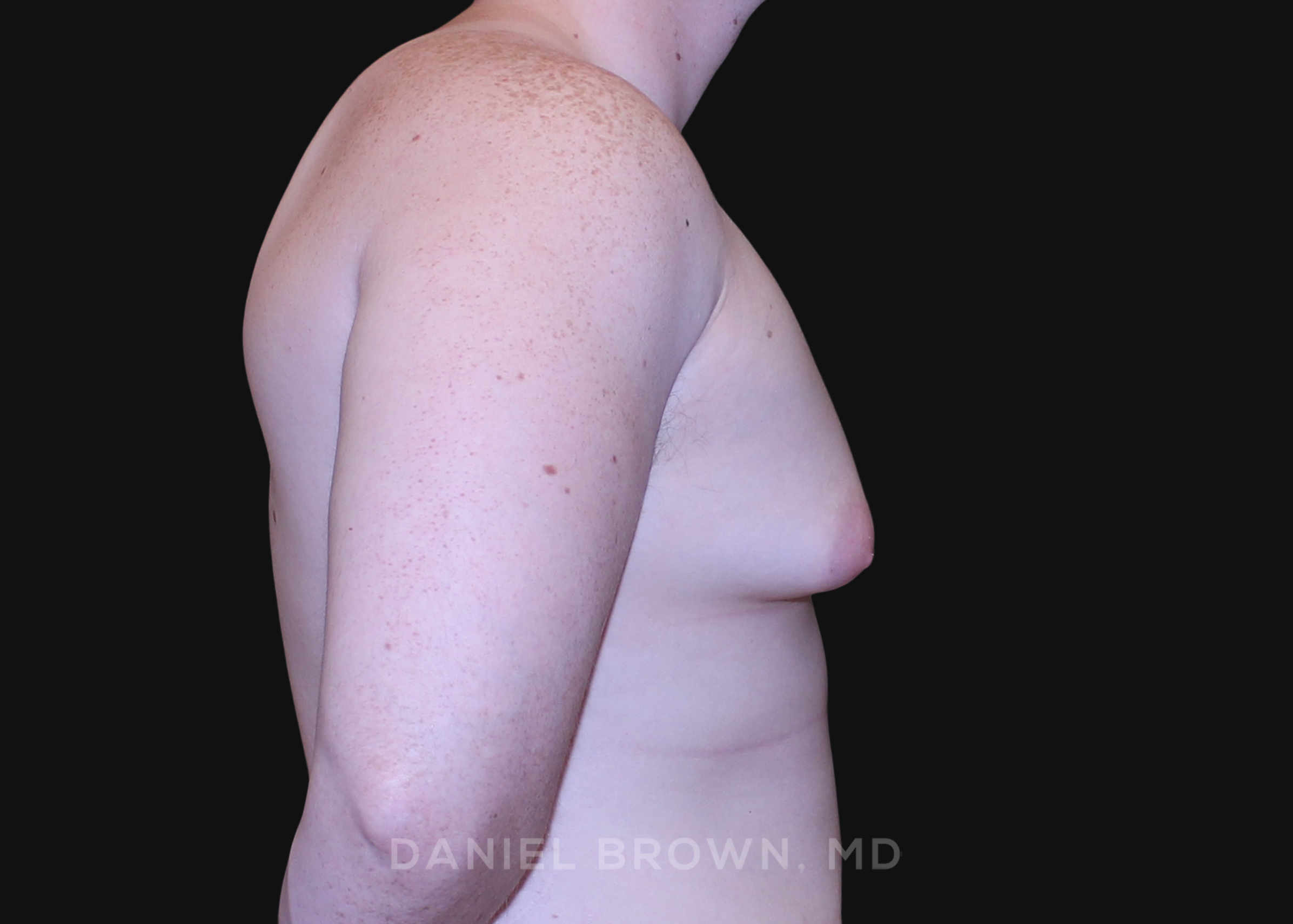 Male Breast Reduction Patient Photo - Case 2602 - before view-4