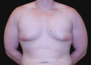 Male Breast Reduction - Case 2602 - Before