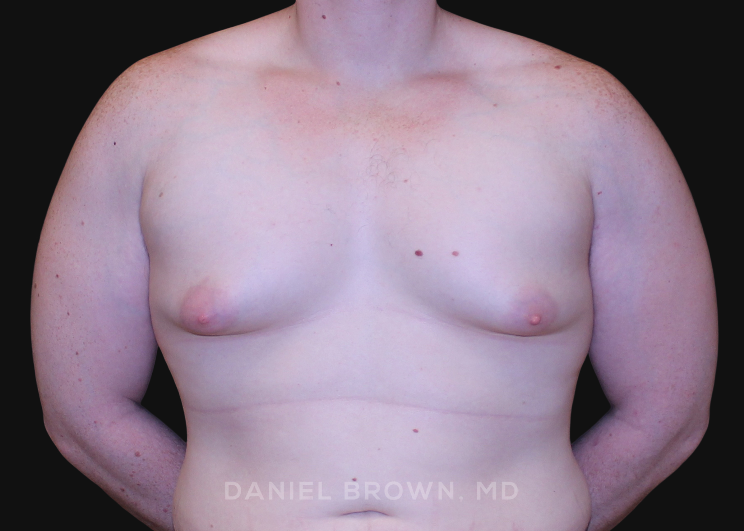 Male Breast Reduction Patient Photo - Case 2602 - before view-0