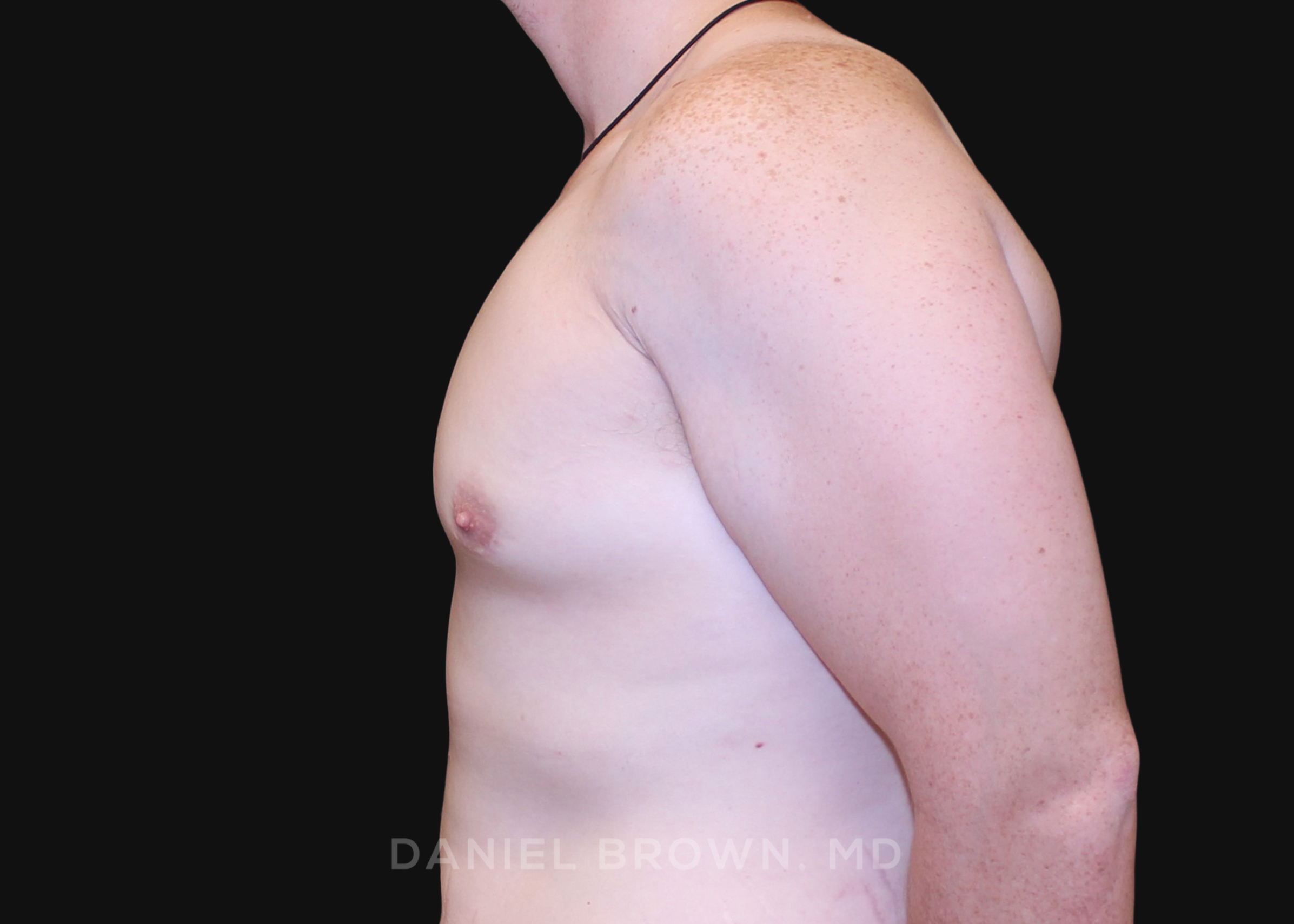 Male Breast Reduction Patient Photo - Case 2602 - after view