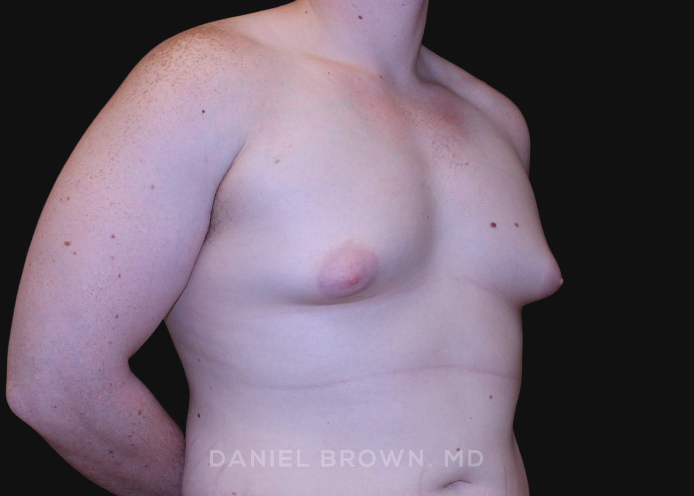 Male Breast Reduction Patient Photo - Case 2602 - before view-2