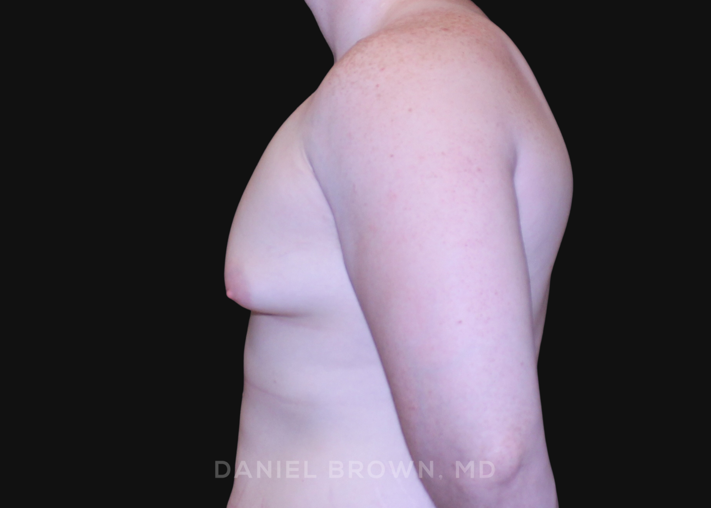 Male Breast Reduction Patient Photo - Case 2602 - before view-
