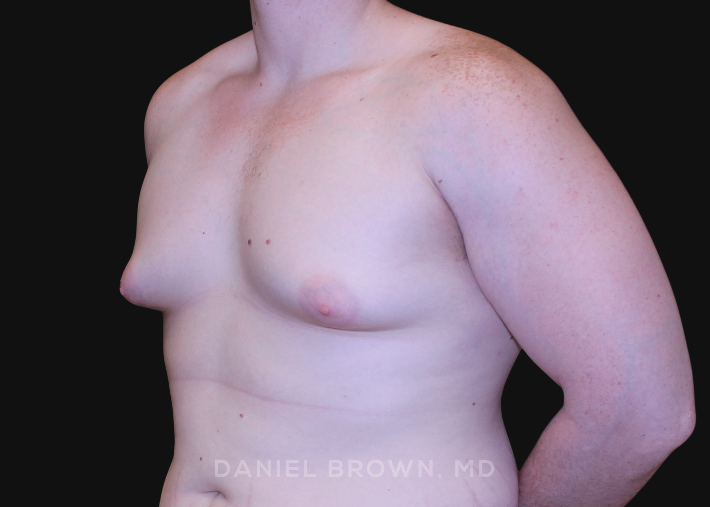 Male Breast Reduction Patient Photo - Case 2602 - before view-1
