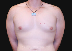Male Breast Reduction - Case 2602 - After