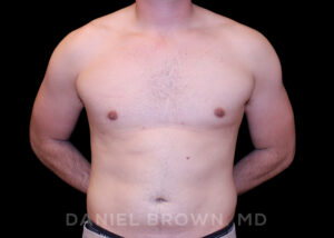 Male Breast Reduction - Case 2614 - After
