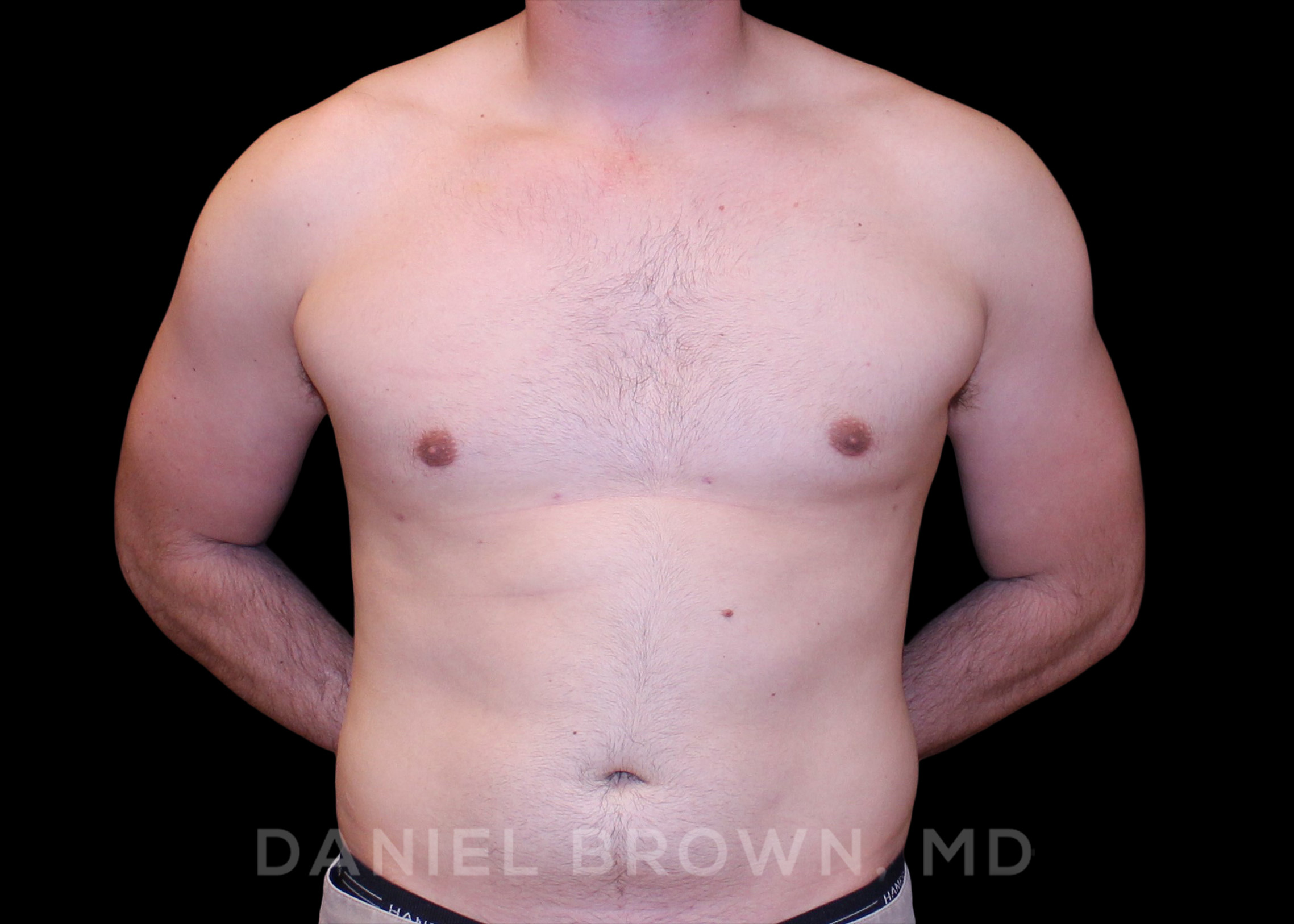 Male Breast Reduction Patient Photo - Case 2614 - after view-0