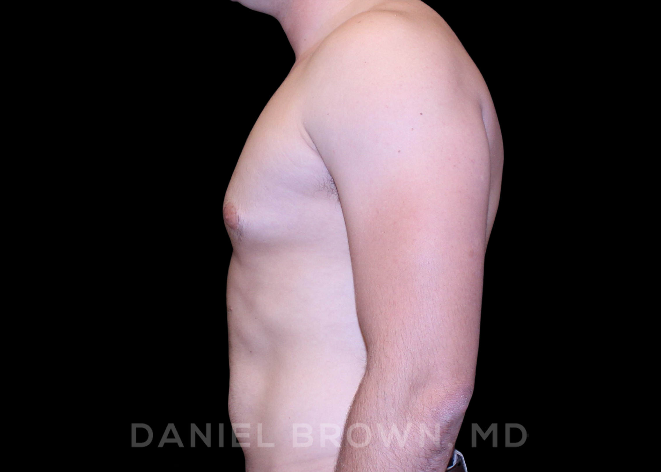 Male Breast Reduction Patient Photo - Case 2614 - after view
