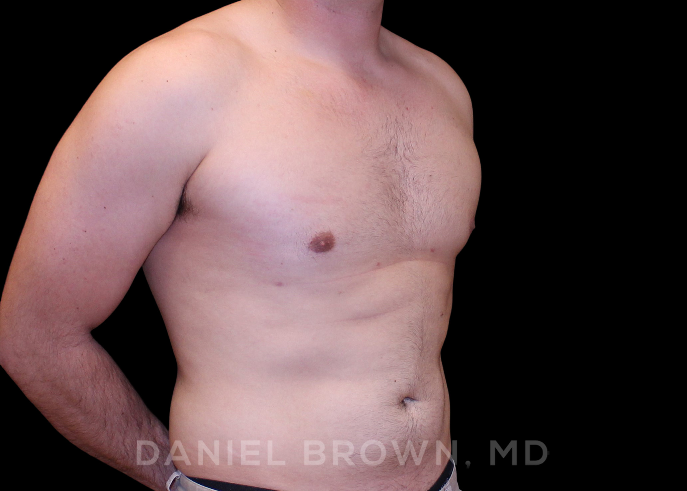 Male Breast Reduction Patient Photo - Case 2614 - before view-