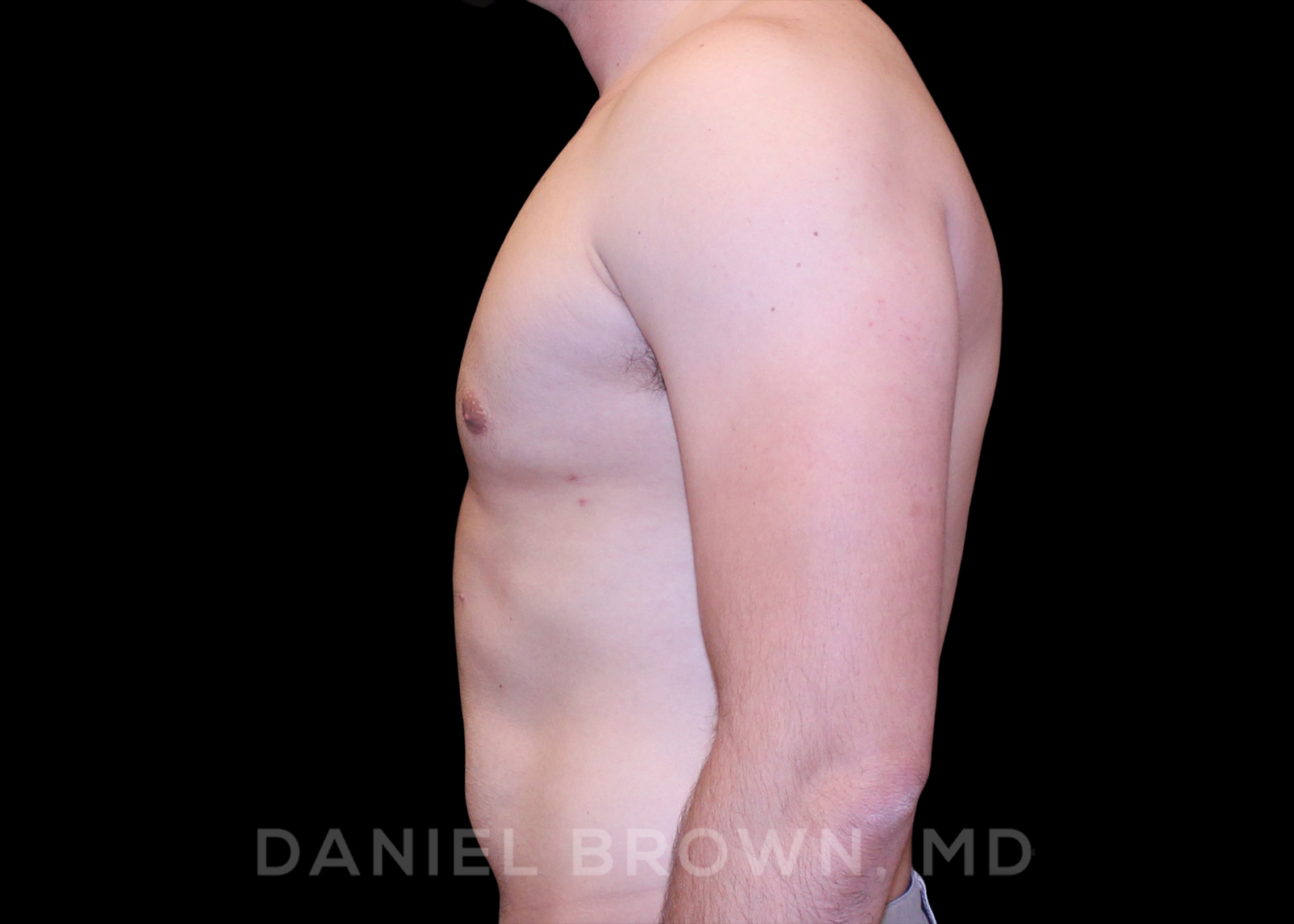 Male Breast Reduction Patient Photo - Case 2614 - after view-4