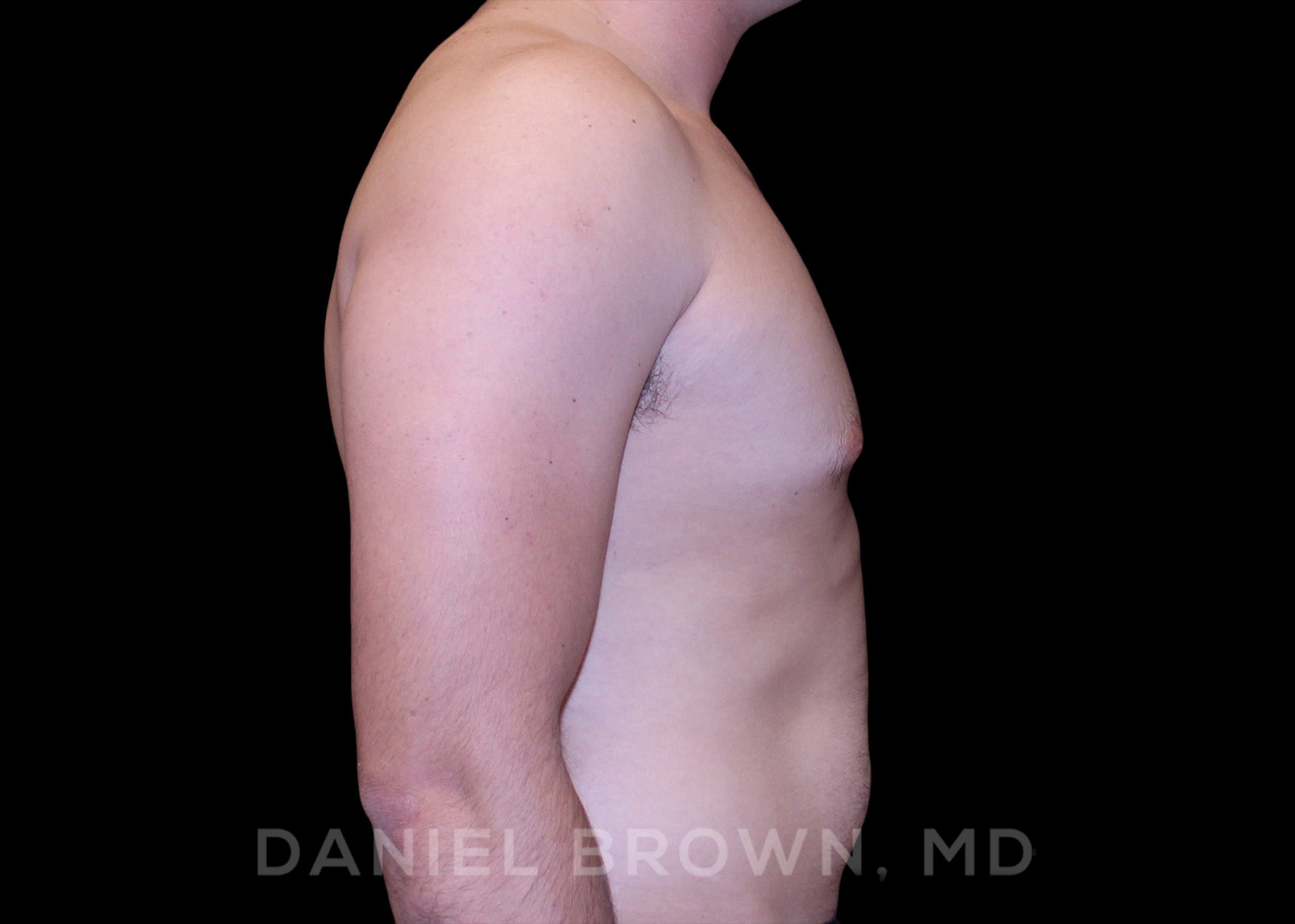 Male Breast Reduction Patient Photo - Case 2614 - before view-