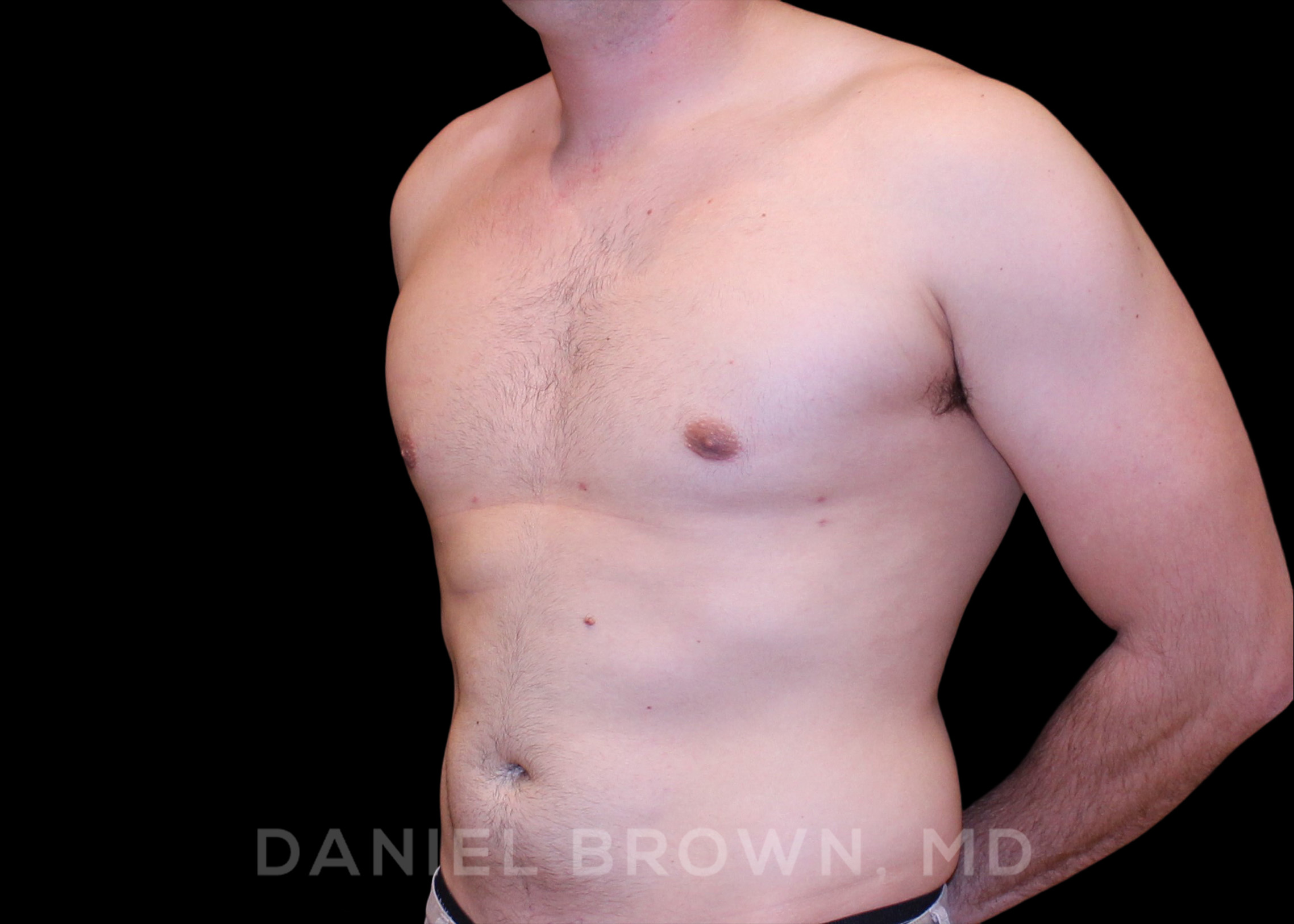 Male Breast Reduction Patient Photo - Case 2614 - after view
