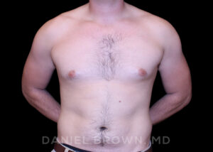 Male Breast Reduction - Case 2614 - Before