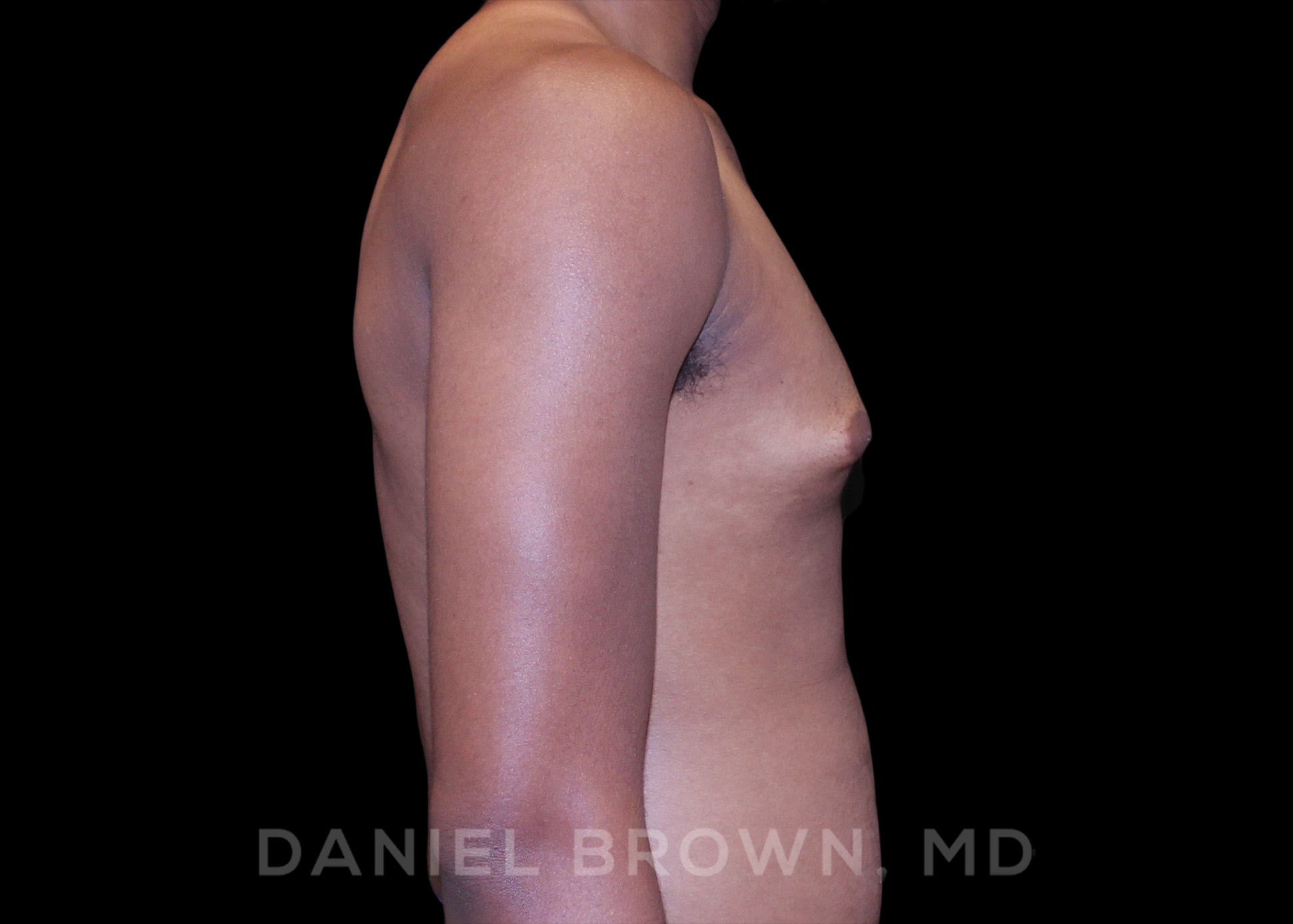 Male Breast Reduction Patient Photo - Case 2625 - before view-
