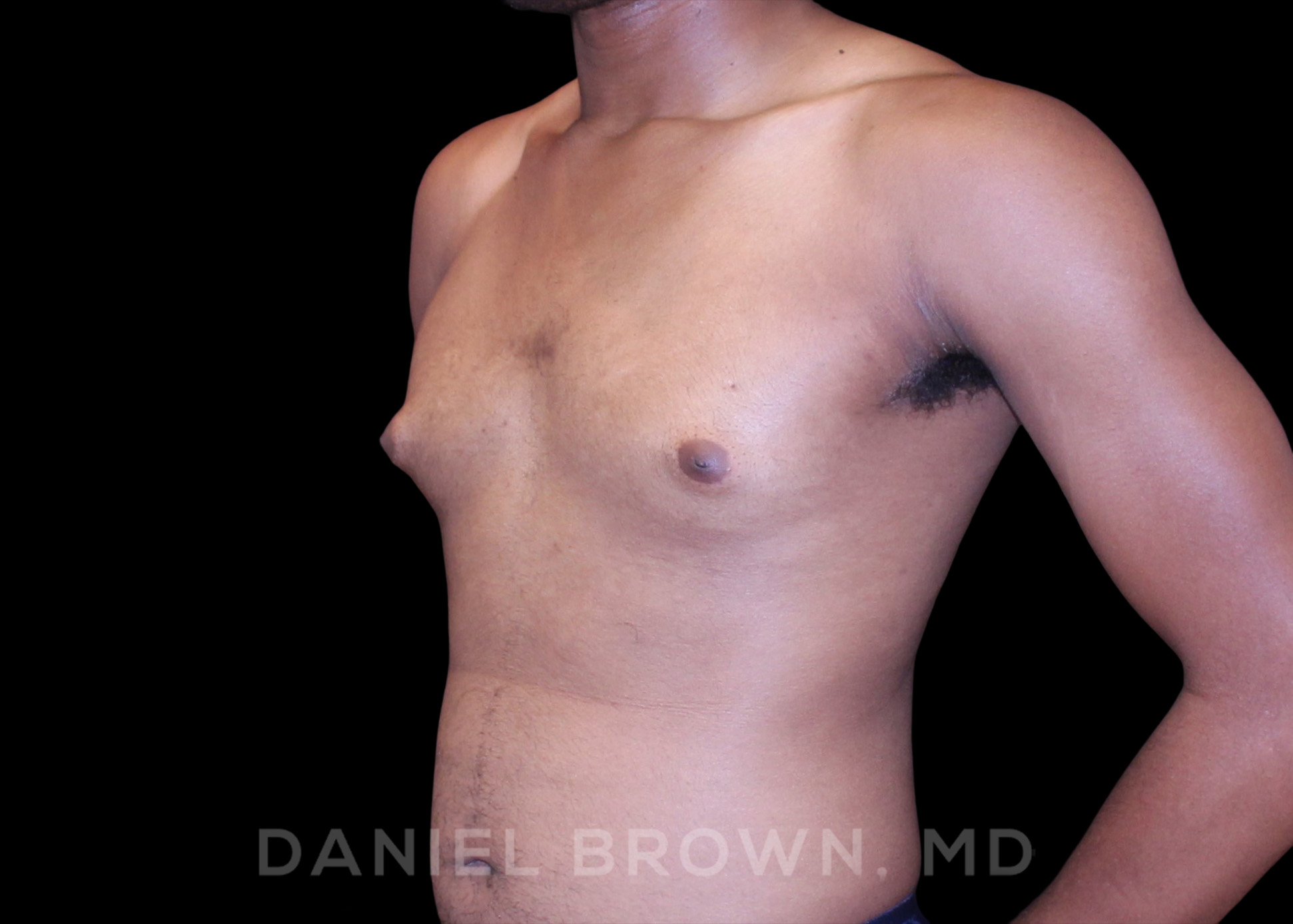 Male Breast Reduction Patient Photo - Case 2625 - before view-