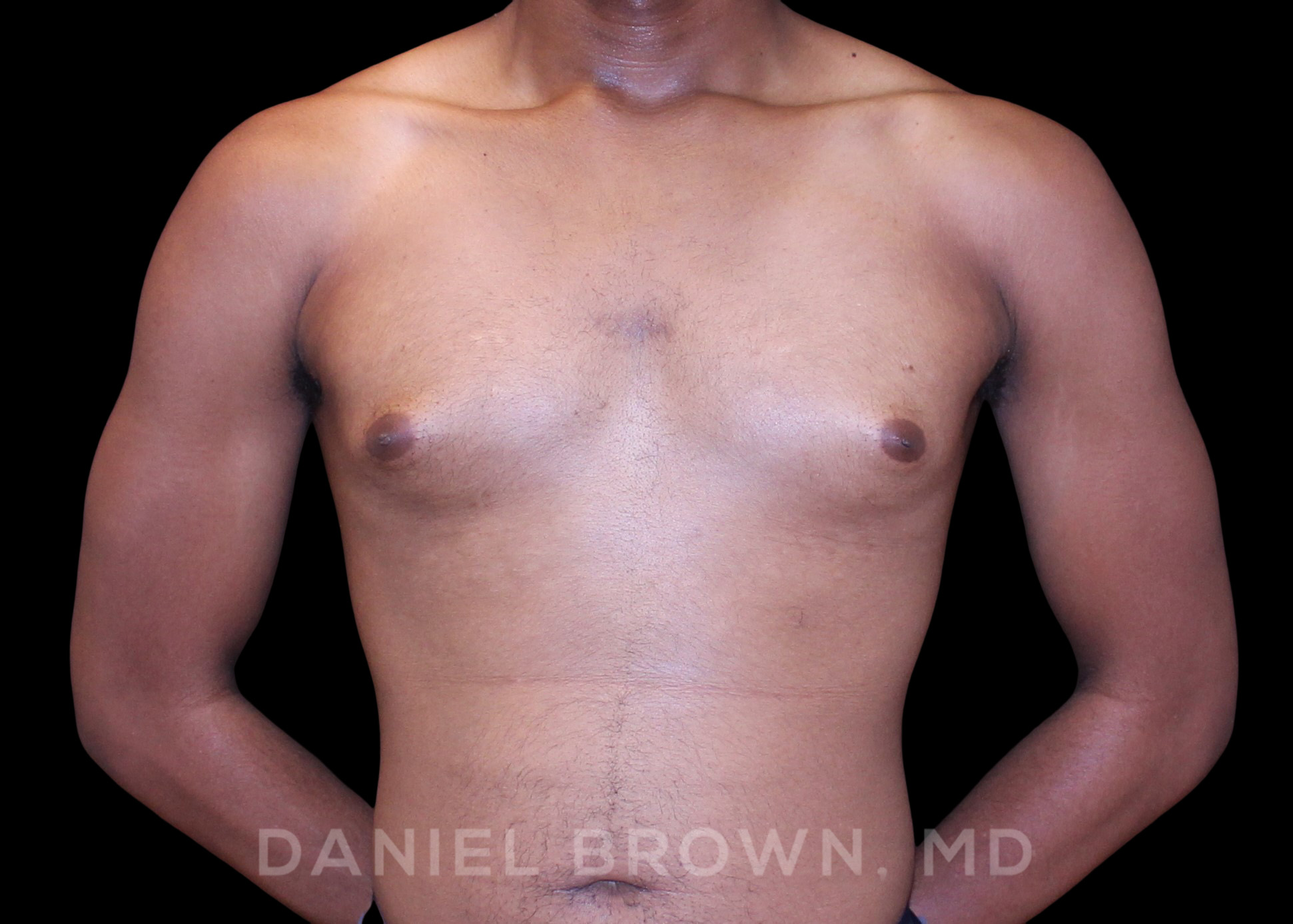 Male Breast Reduction Patient Photo - Case 2625 - before view-0