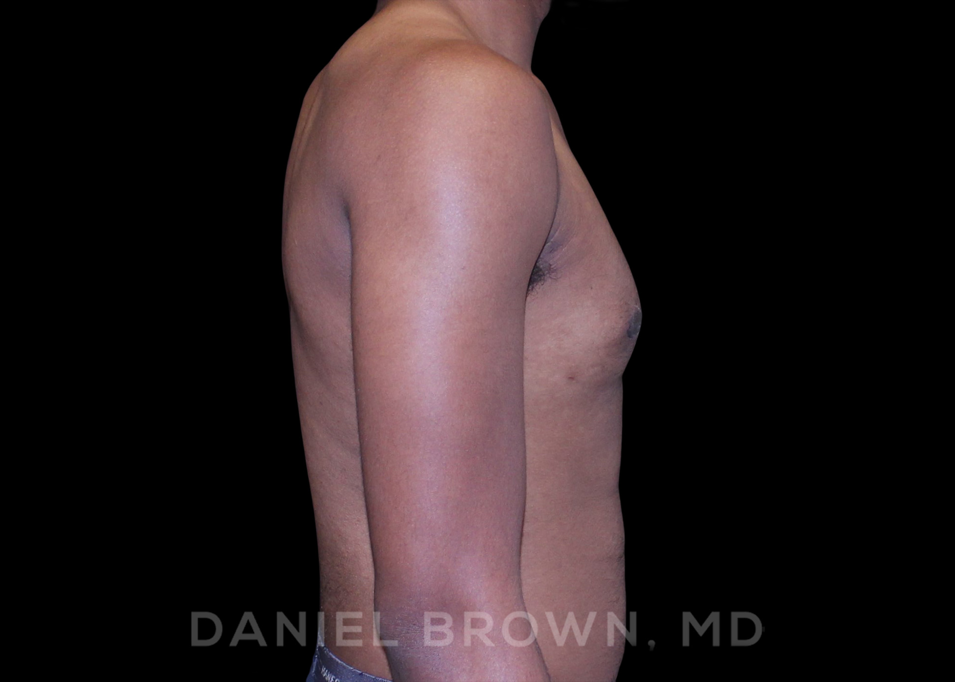 Male Breast Reduction Patient Photo - Case 2625 - after view