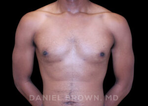 Male Breast Reduction - Case 2625 - After