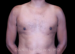 Male Breast Reduction - Case 2636 - After