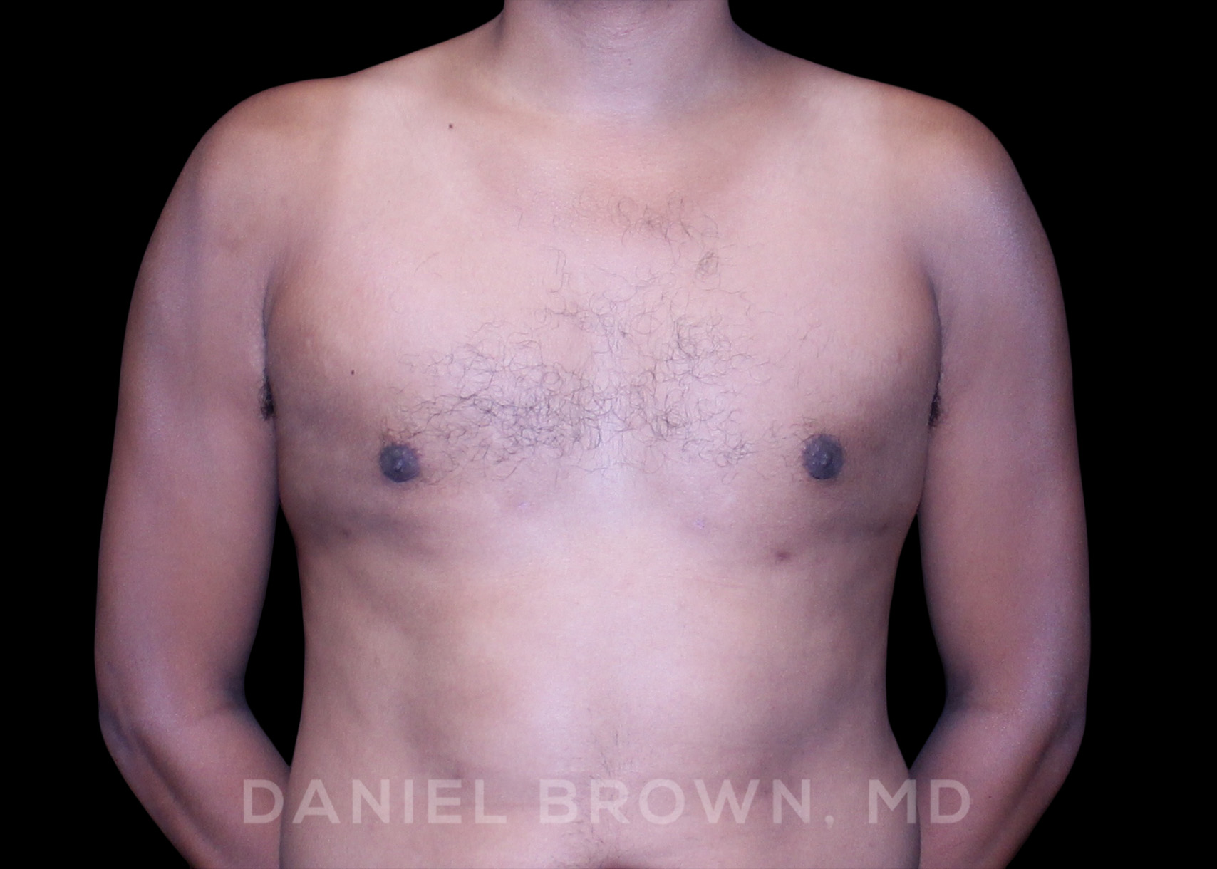 Male Breast Reduction Patient Photo - Case 2636 - after view