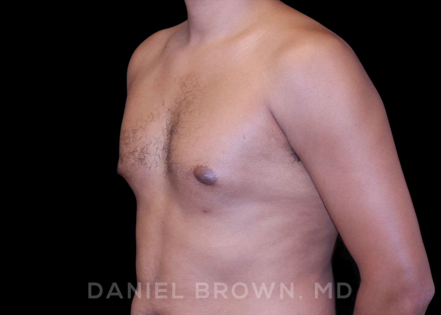 Male Breast Reduction Patient Photo - Case 2636 - before view-