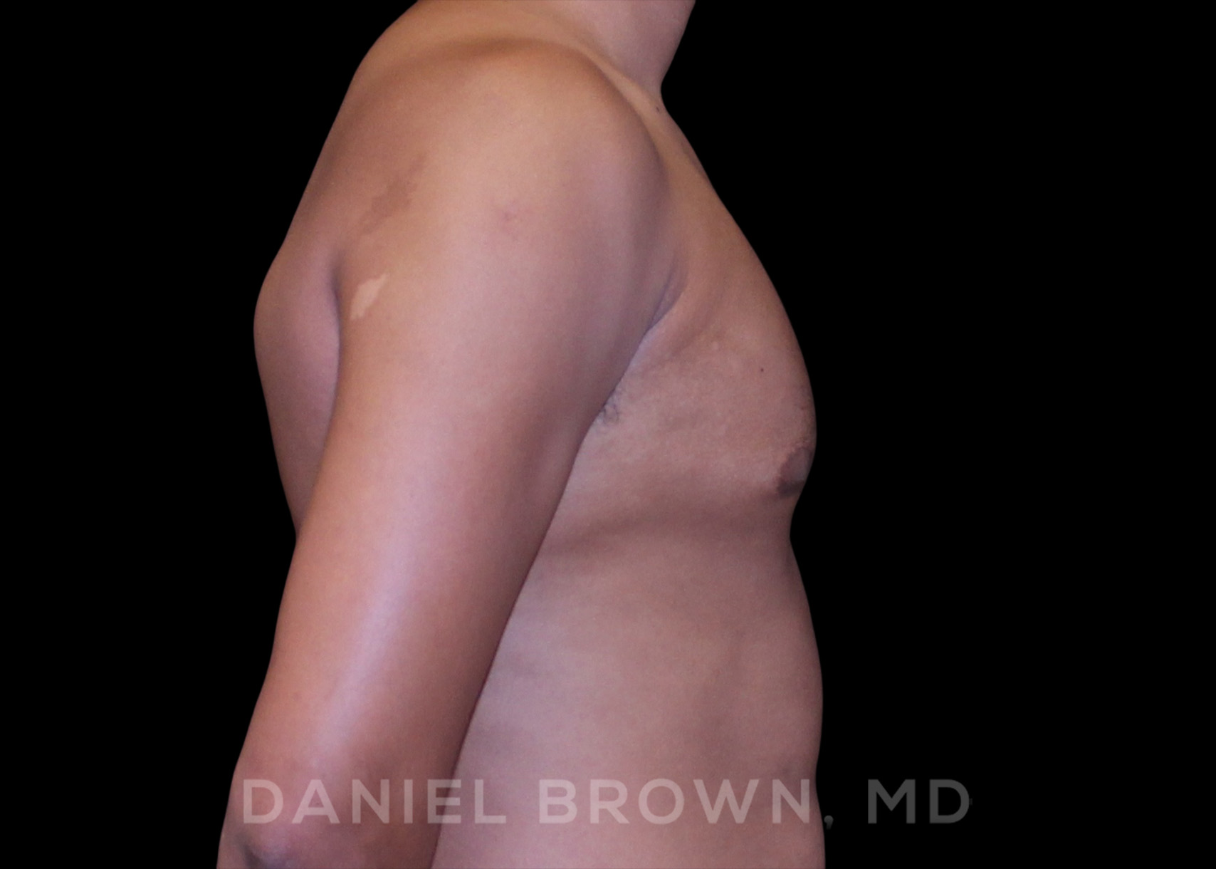 Male Breast Reduction Patient Photo - Case 2636 - before view-