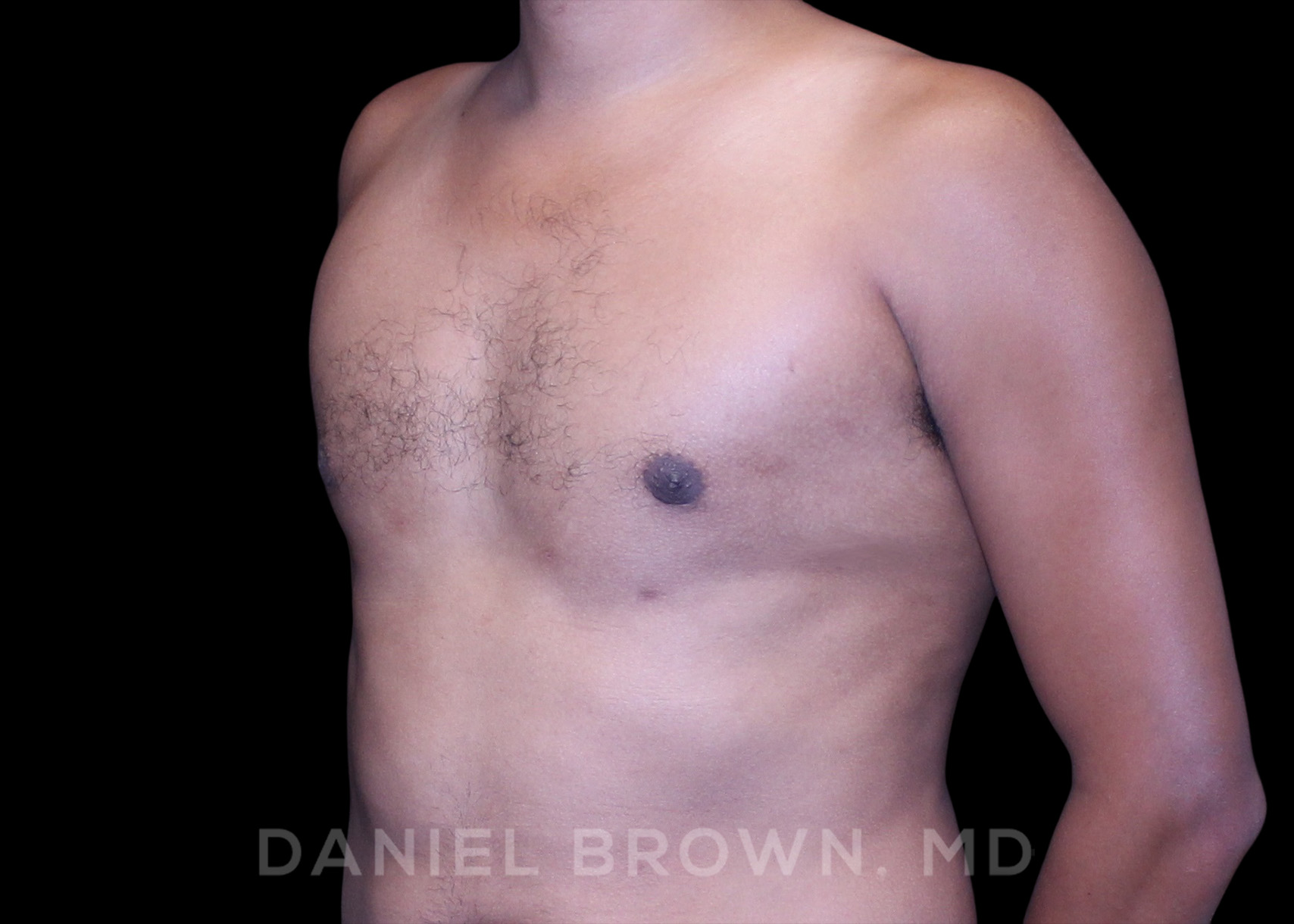 Male Breast Reduction Patient Photo - Case 2636 - after view-1