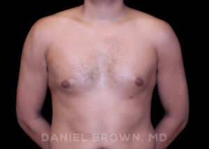Male Breast Reduction - Case 2636 - Before