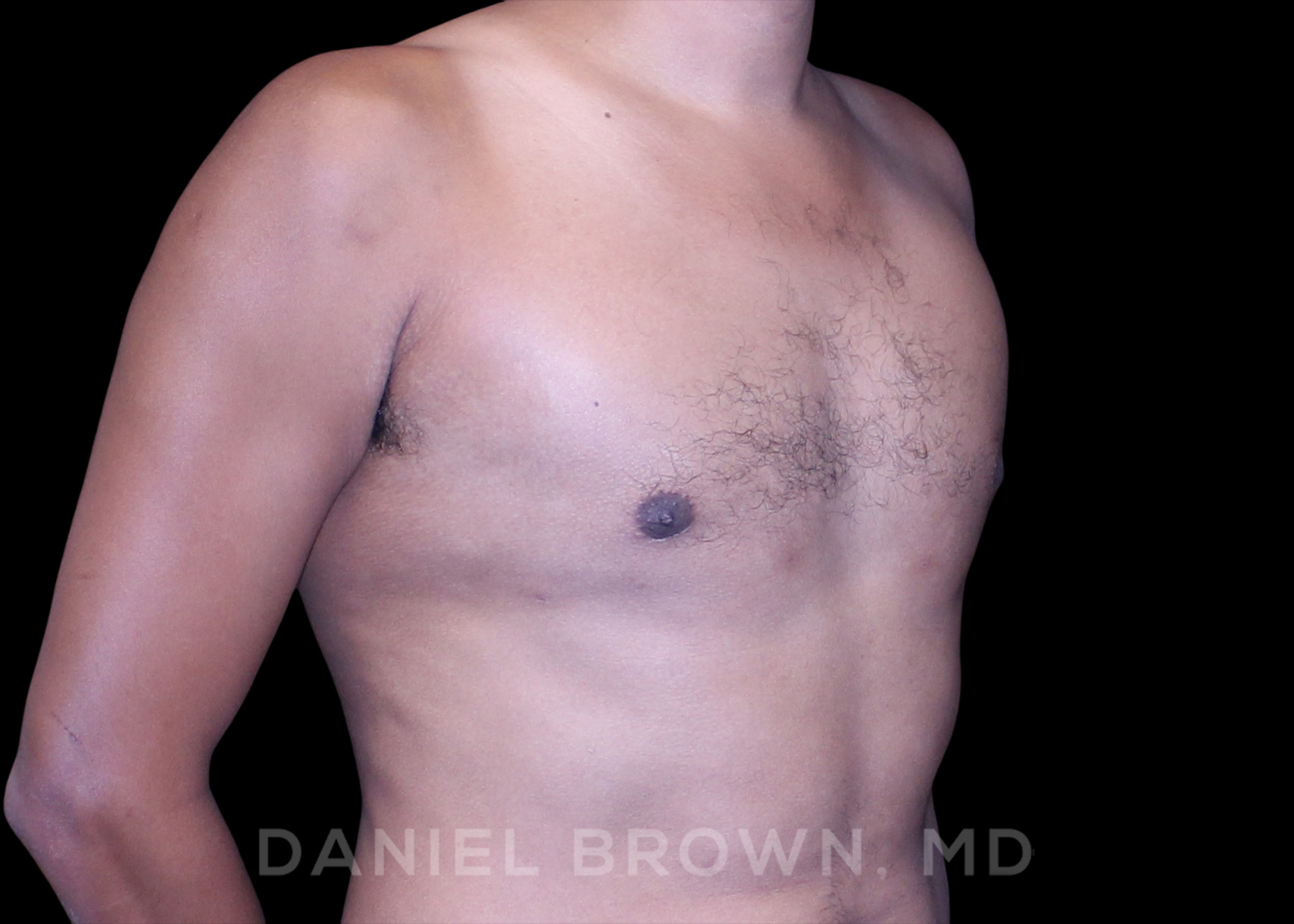 Male Breast Reduction Patient Photo - Case 2636 - after view