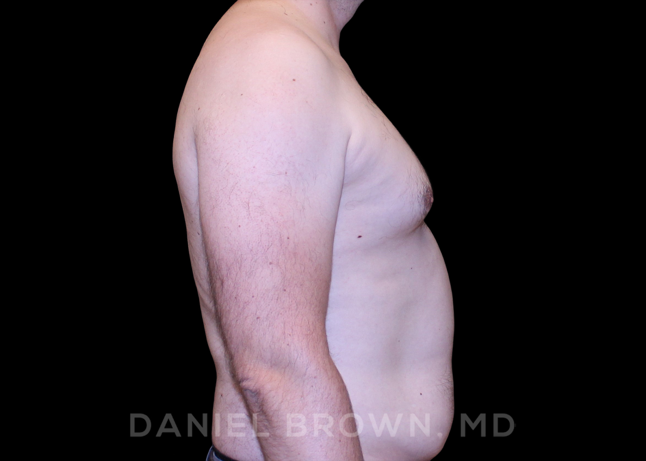Male Breast Reduction Patient Photo - Case 2647 - before view-