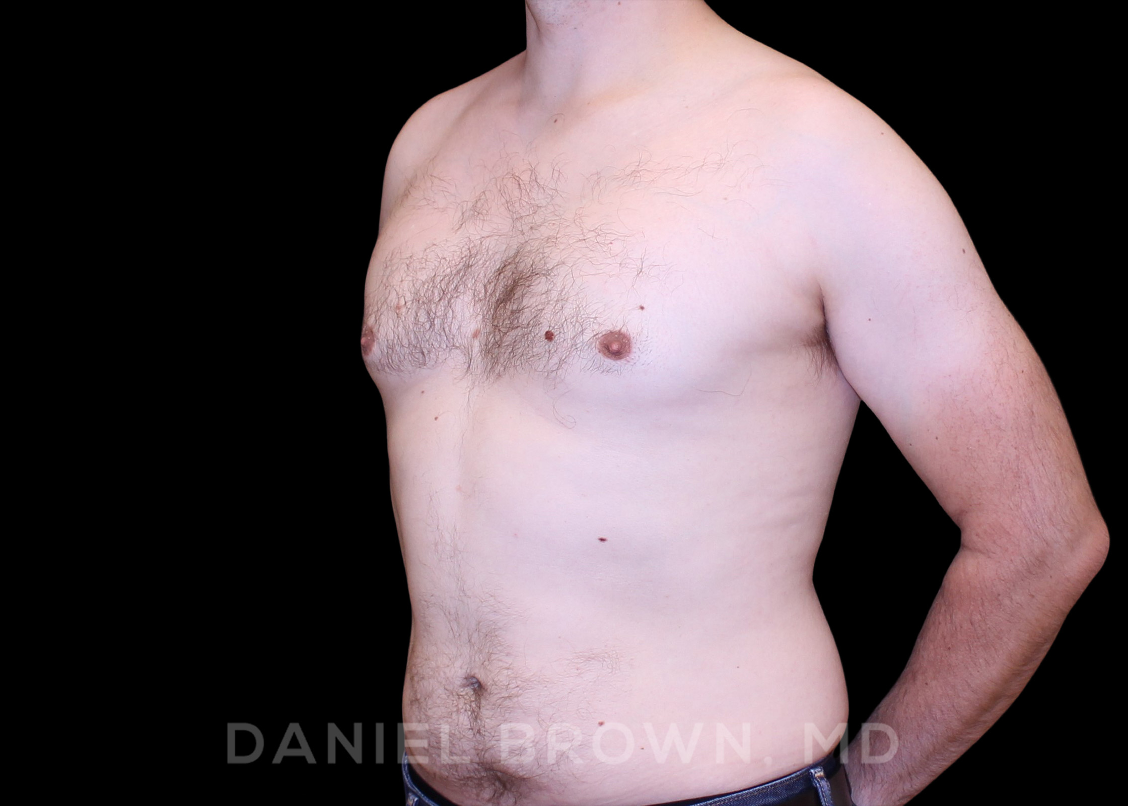 Male Breast Reduction Patient Photo - Case 2647 - after view