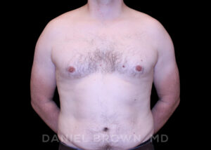 Male Breast Reduction - Case 2647 - Before