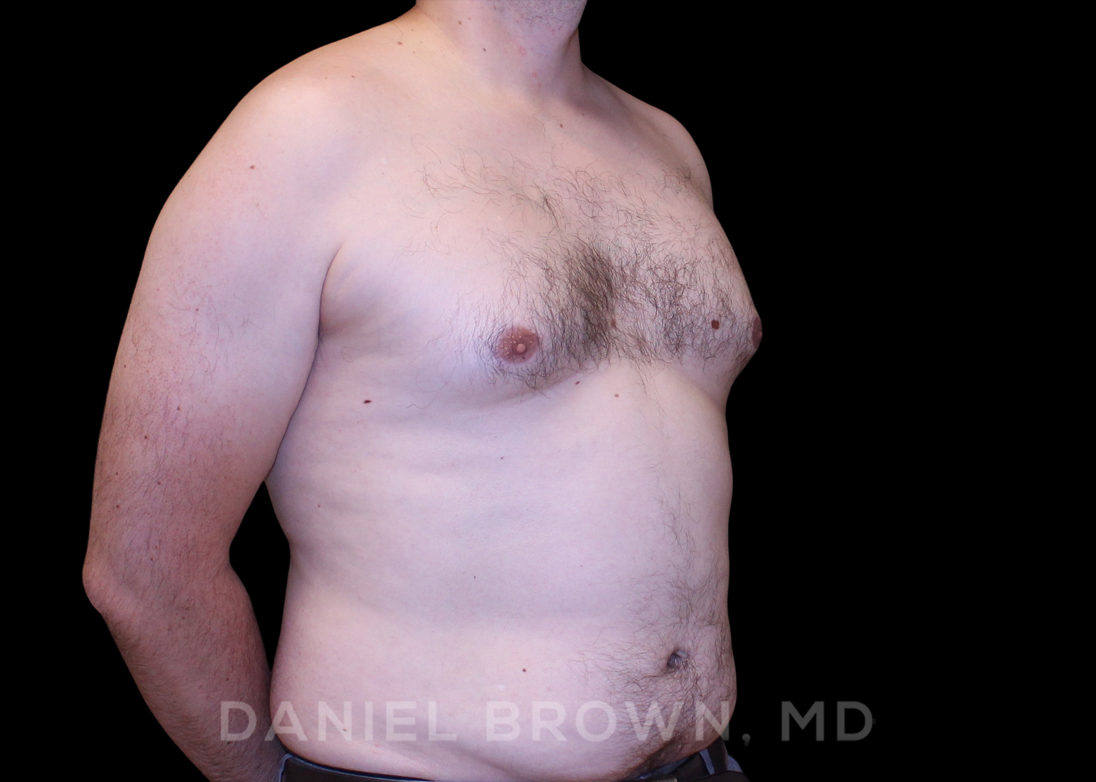 Male Breast Reduction Patient Photo - Case 2647 - before view-