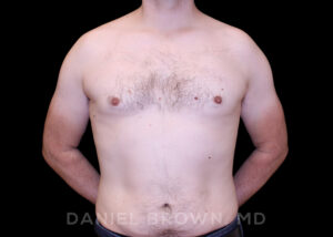 Male Breast Reduction - Case 2647 - After
