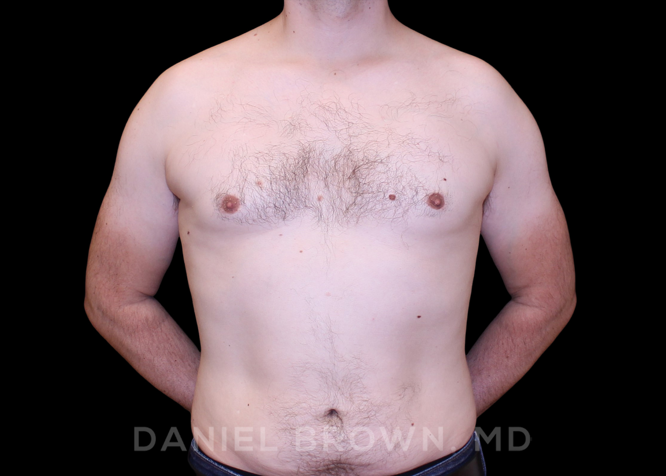 Male Breast Reduction Patient Photo - Case 2647 - after view