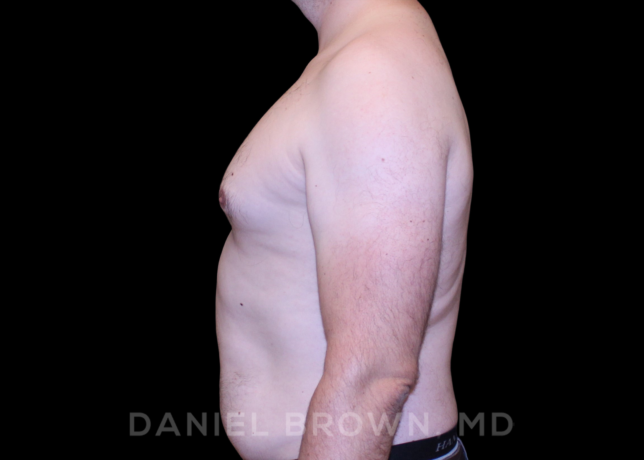 Male Breast Reduction Patient Photo - Case 2647 - before view-3