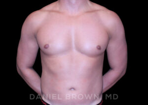 Male Breast Reduction - Case 2658 - After