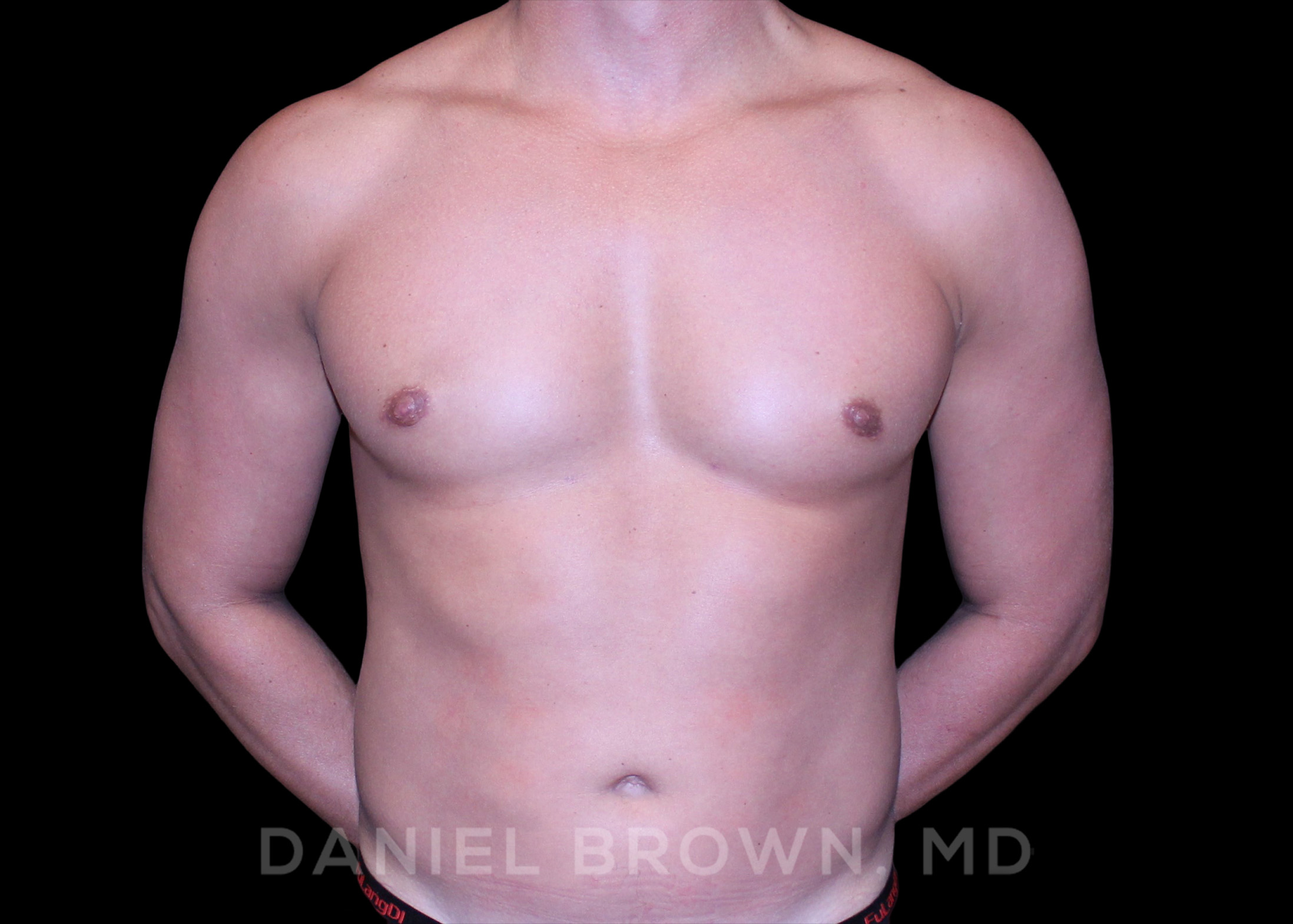 Male Breast Reduction Patient Photo - Case 2658 - after view