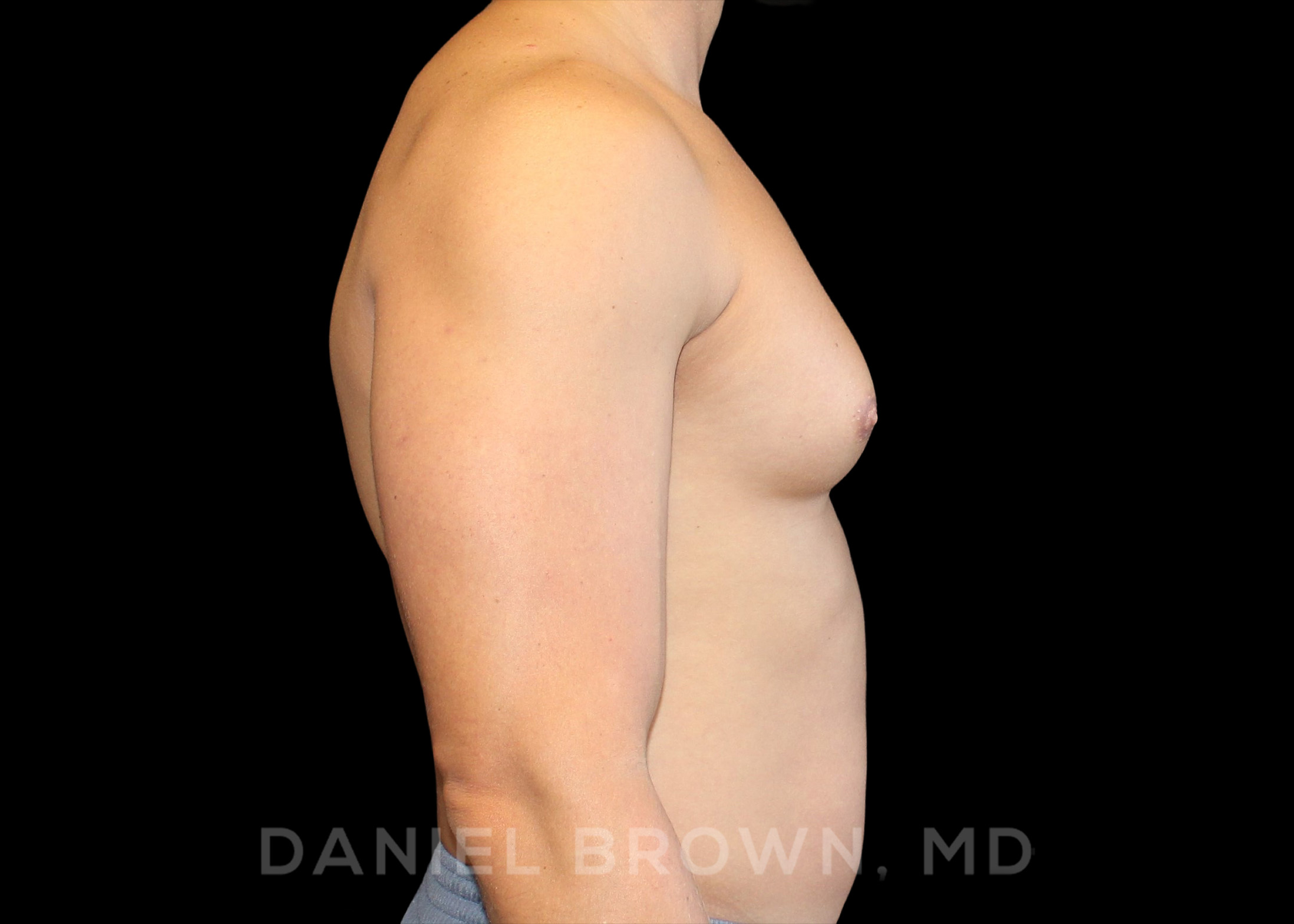 Male Breast Reduction Patient Photo - Case 2658 - before view-4