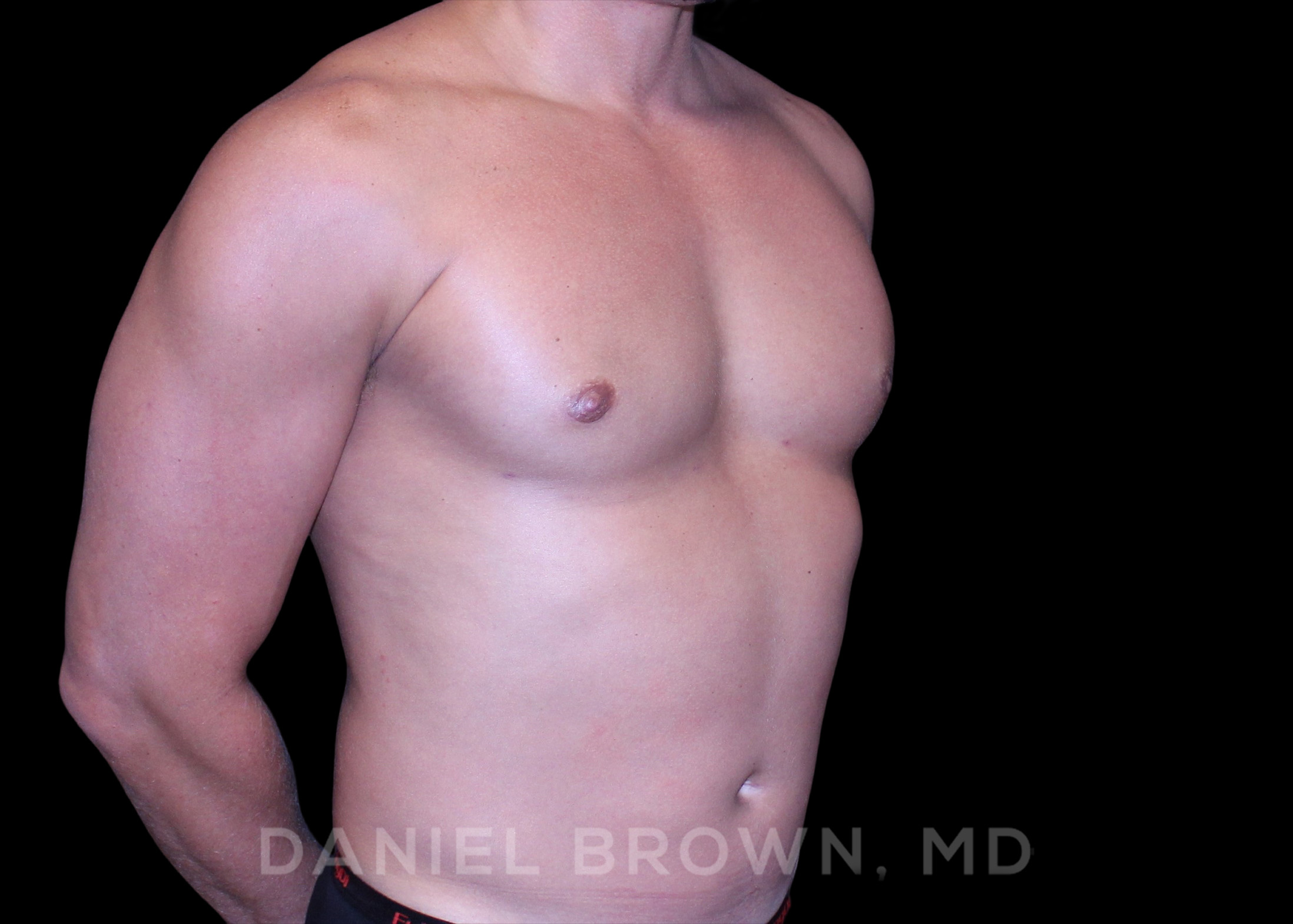 Male Breast Reduction Patient Photo - Case 2658 - after view-2