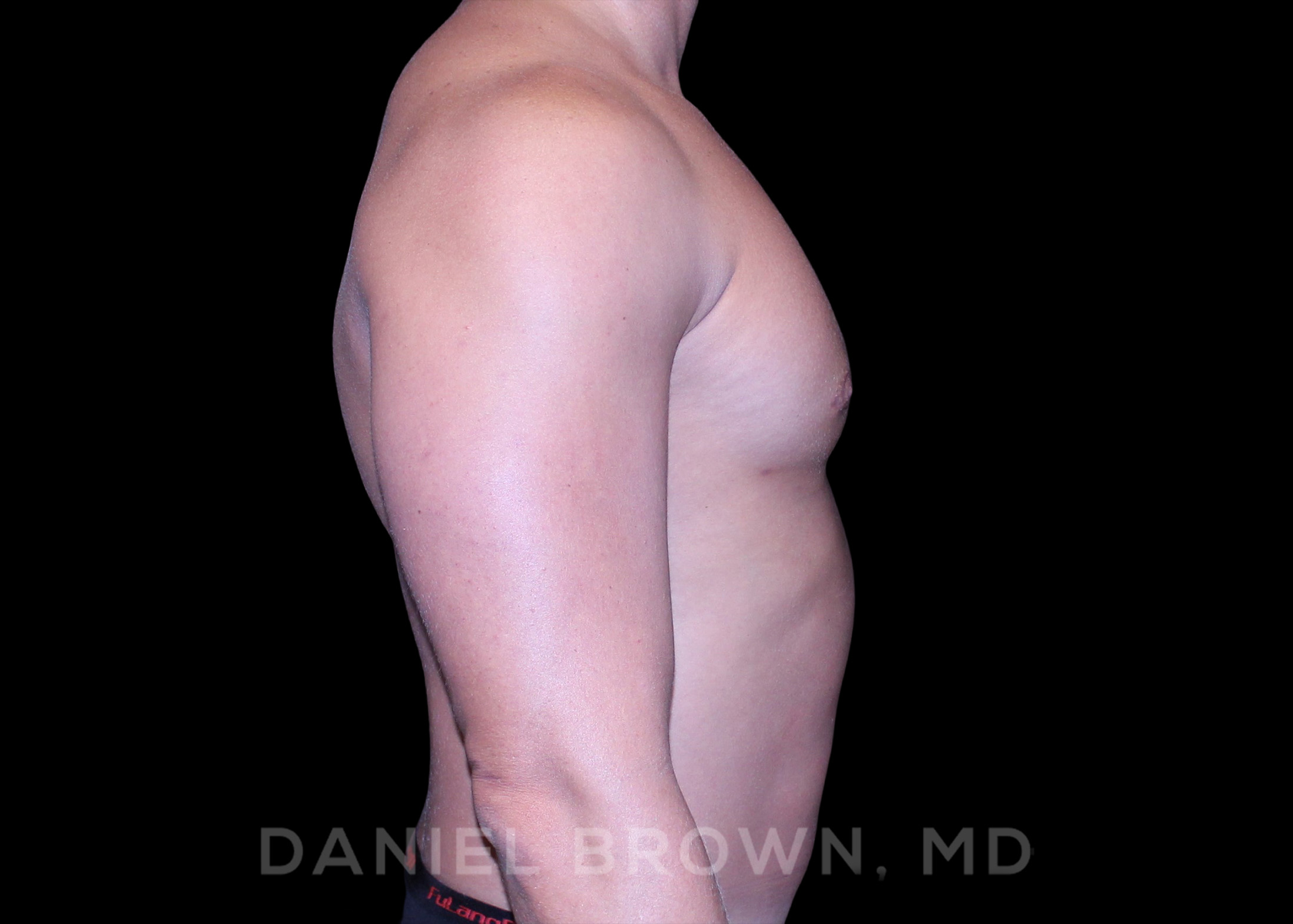 Male Breast Reduction Patient Photo - Case 2658 - after view-4