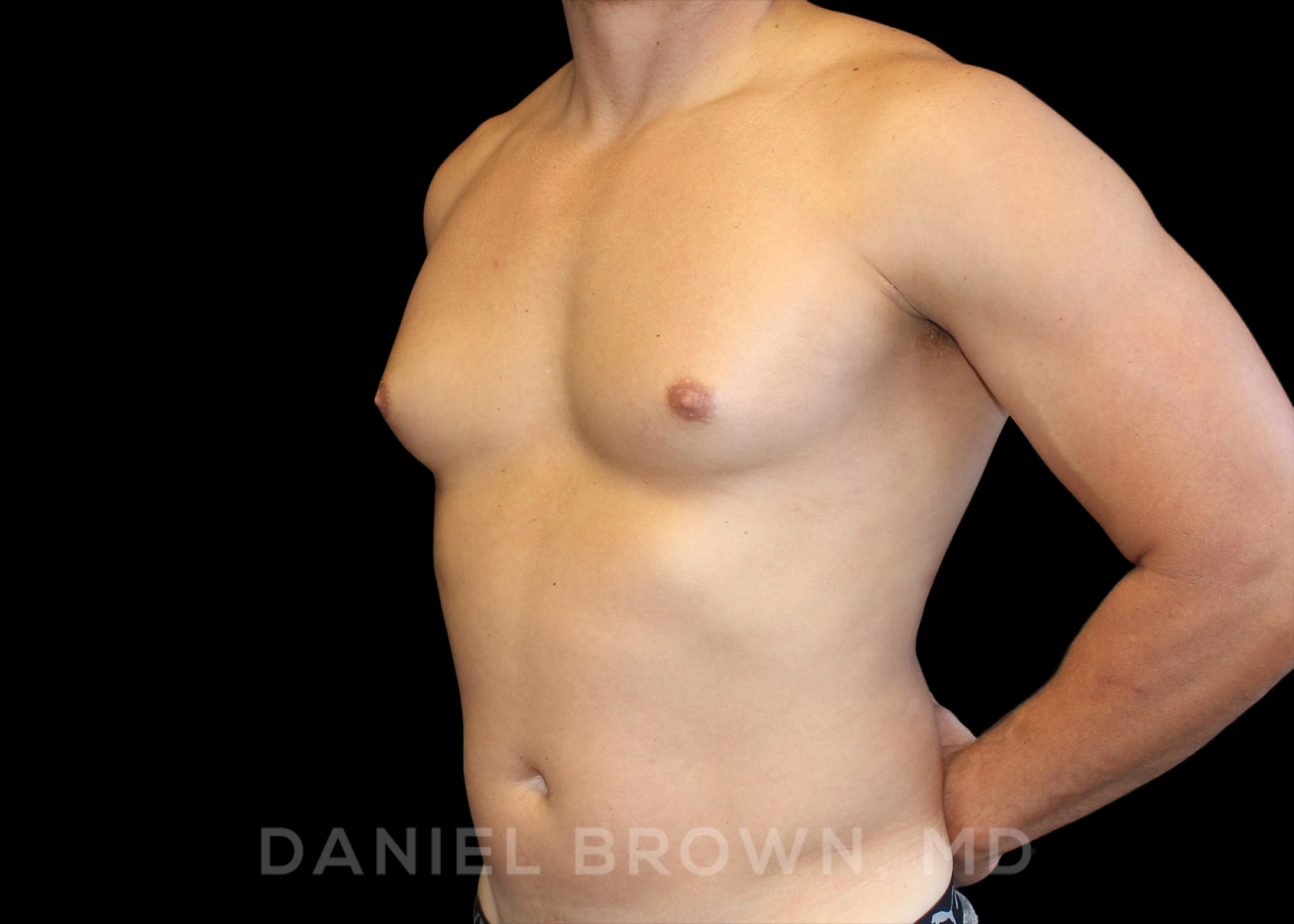 Male Breast Reduction Patient Photo - Case 2658 - before view-1