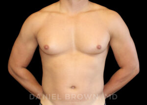 Male Breast Reduction - Case 2658 - Before