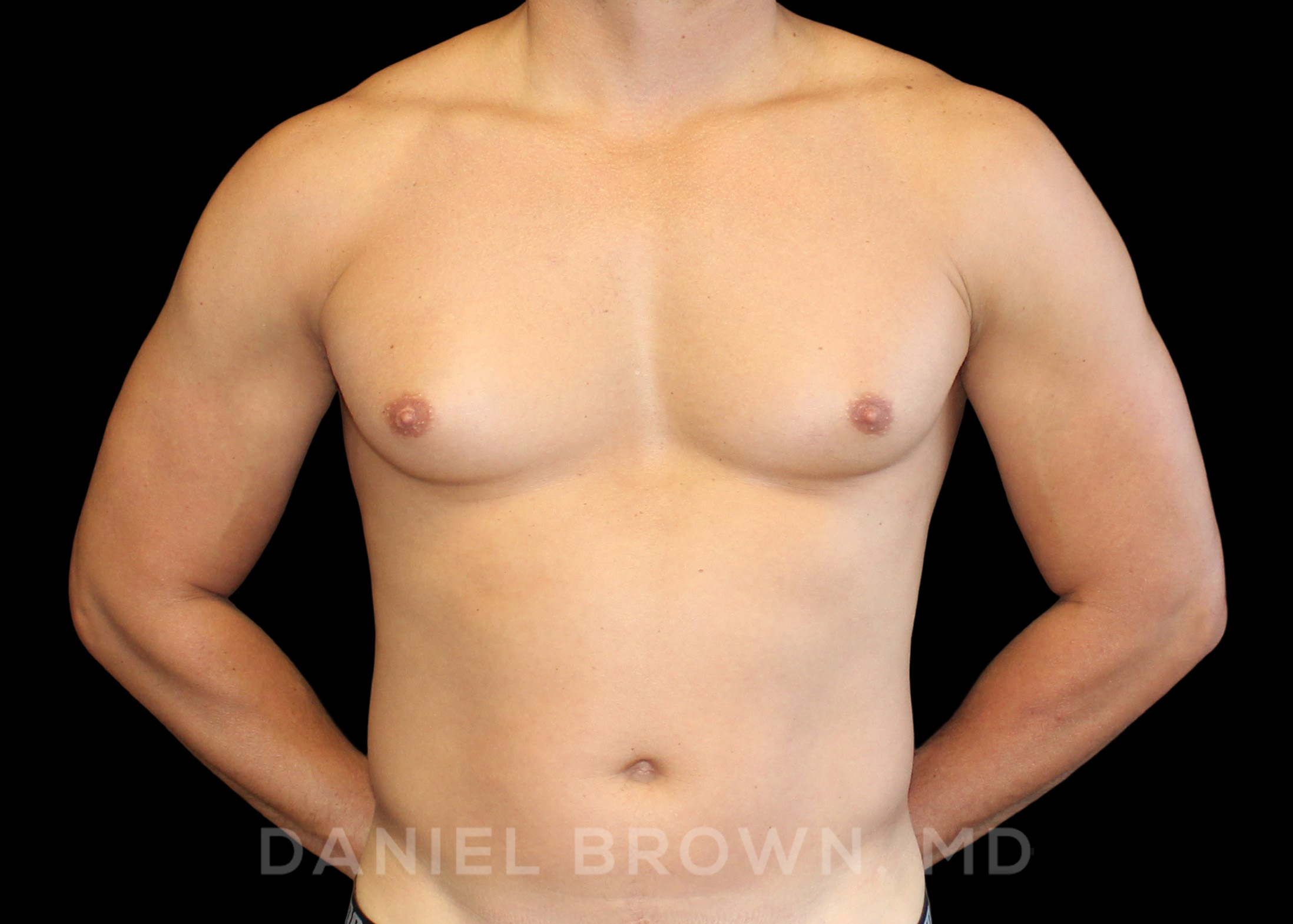 Male Breast Reduction Patient Photo - Case 2658 - before view-